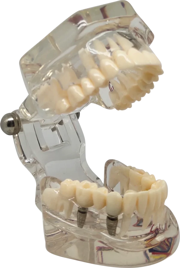 Implant Tooth Model