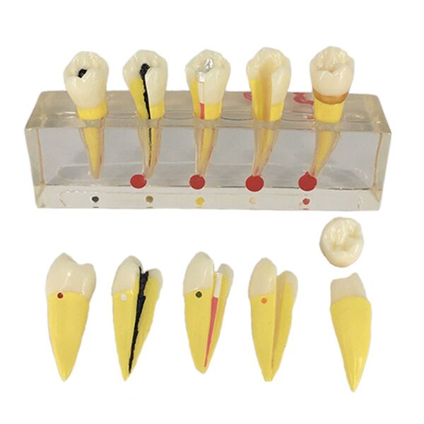 Pulp Disease Study Model